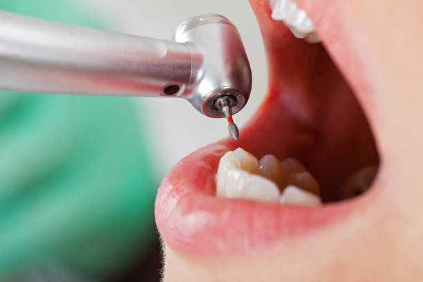 Best Emergency Dental Care for Broken or Chipped Teeth in Rigby, ID